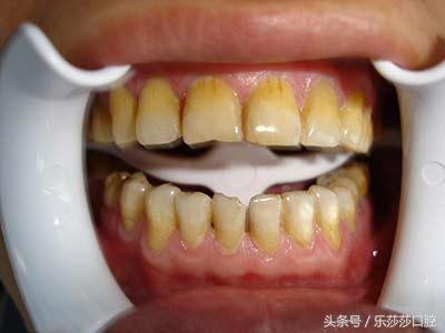 史上最全牙齿美白方法，没有之一！