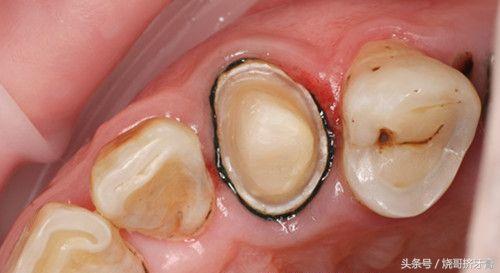 真相解密：根管治疗后牙齿到底能用多久？