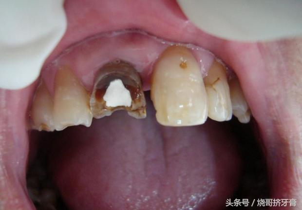 牙齿做根管治疗真的会痛吗？