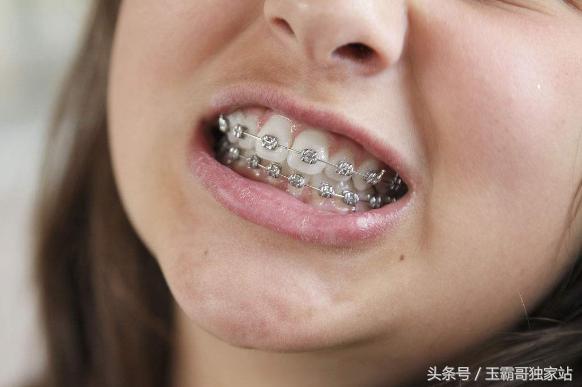 噩梦般的十年整牙之路，十年青春矫正牙齿值得吗？
