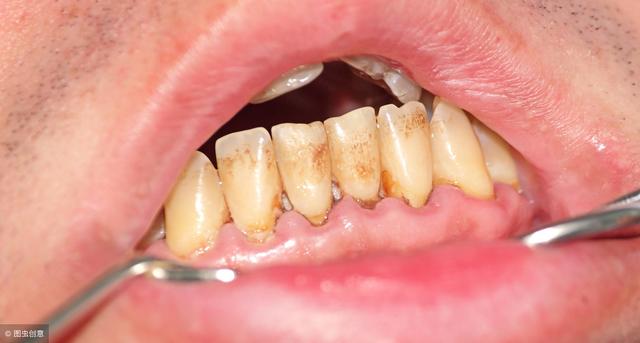 牙龈总出血，是在暗示什么？医生：若排除这5种病，好好刷牙就行
