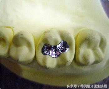 根管治疗后，为保护牙齿，做嵌体好还是牙套好？