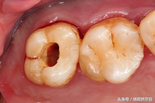 牙齿做根管治疗真的会痛吗？