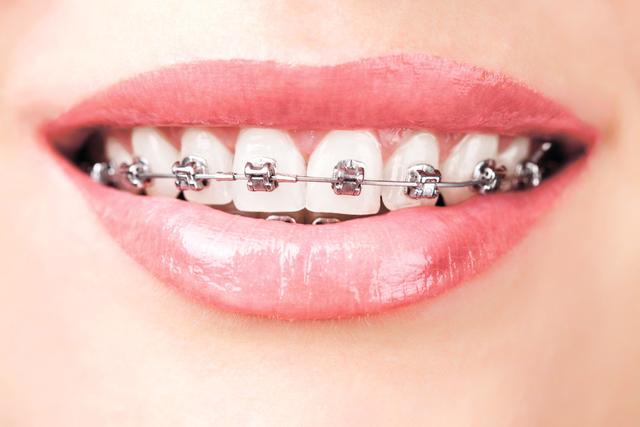 一位牙医爆出牙齿矫正的内幕 80%的人都会震惊