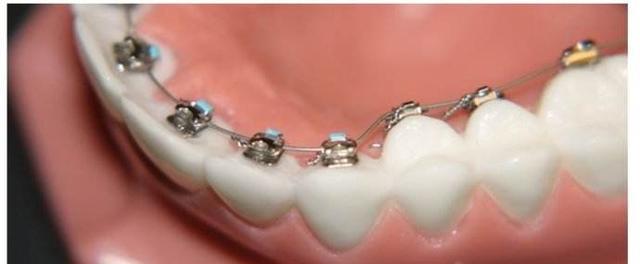 为什么越来越多的人做牙齿矫正？