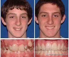 「干货」有多少人不敢矫正牙齿，是因为怕有副作用？