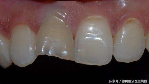 根管治疗后变色，可以做牙齿贴面吗