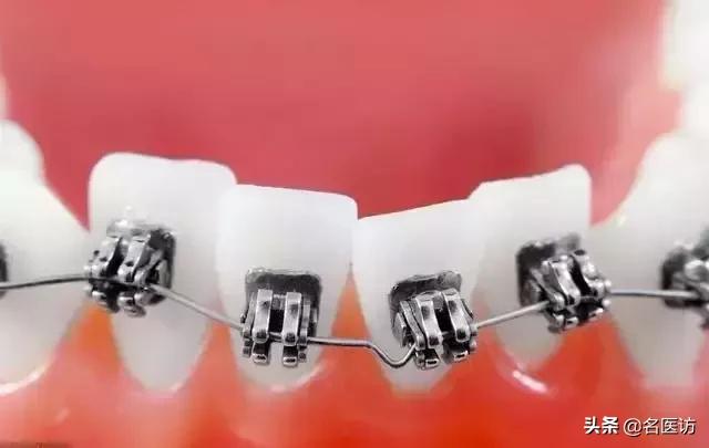 30岁后做牙齿矫正来得及吗？做正畸会有什么危害？