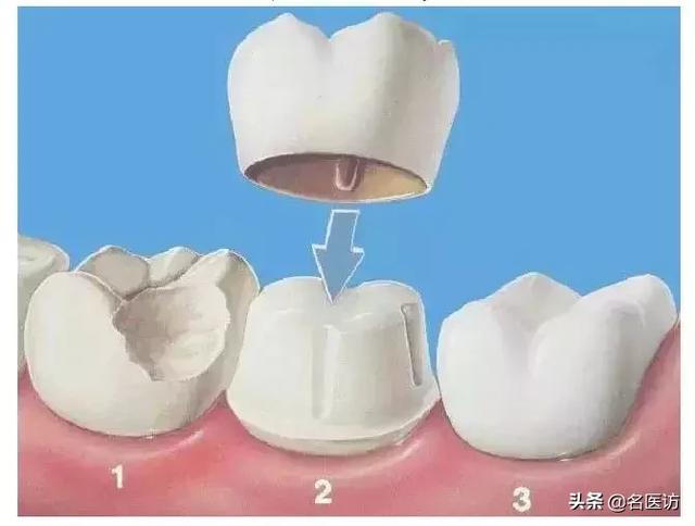 根管治疗后，我的牙齿还能用多久？