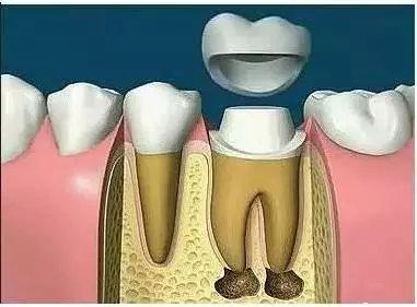 根管治疗后，牙齿到底还能用多久？