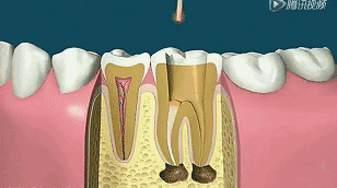 根管治疗后，牙齿到底还能用多久？