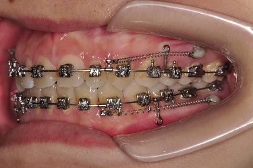 我知道你再犹豫什么，关于「牙齿矫正」的12个心理陷阱！