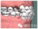 牙齿矫正的20个误区