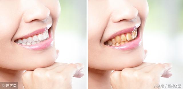 牙黄牙黑，冷光美白牙齿靠谱吗？能保持多久？
