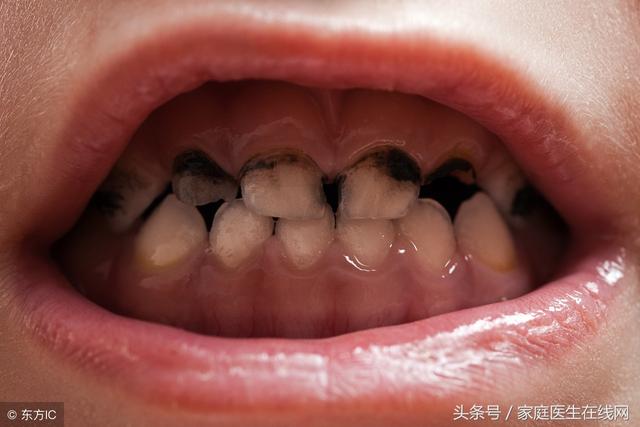 乳牙龋齿是什么原因导致的？会有哪些危害？多少人不了解