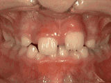 龅牙、地包天、牙齿拥挤…N种正畸过程是这样子滴！【动态图】