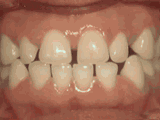 龅牙、地包天、牙齿拥挤…N种正畸过程是这样子滴！【动态图】